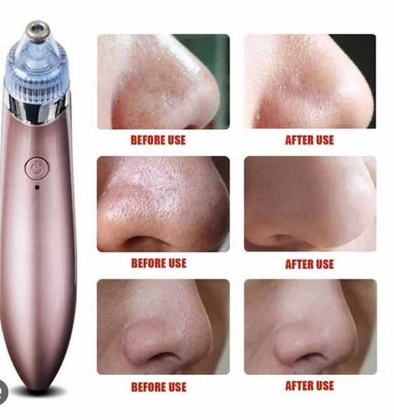 Extractor de Puntos Negros y Espinillas - Florecer Cosmética